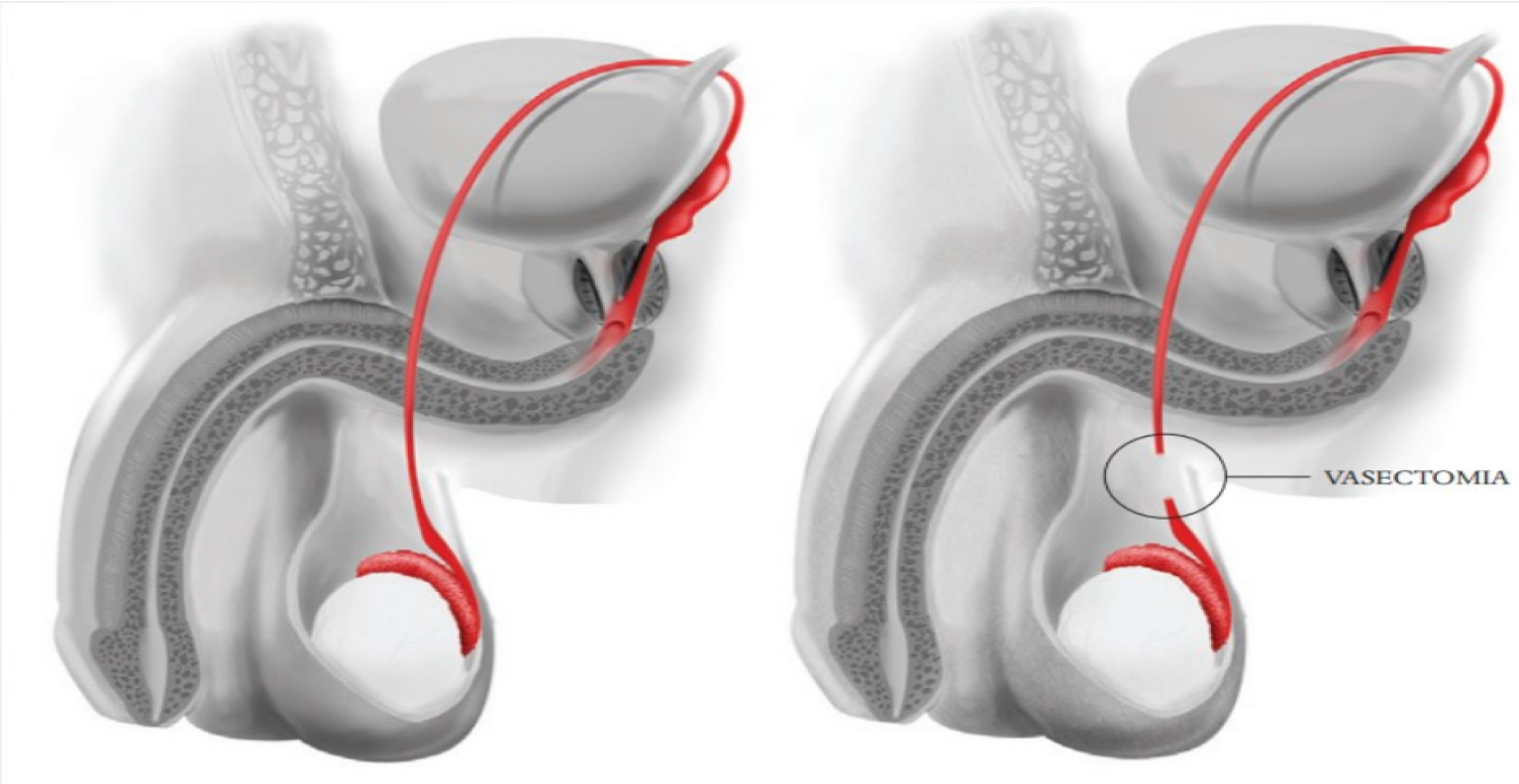 Vasectomia